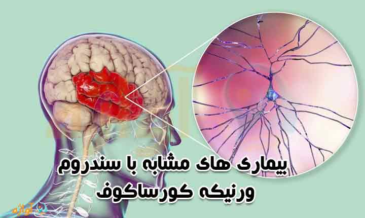 بیماری های مشابه با سندرم ورنیکه کورساکوف